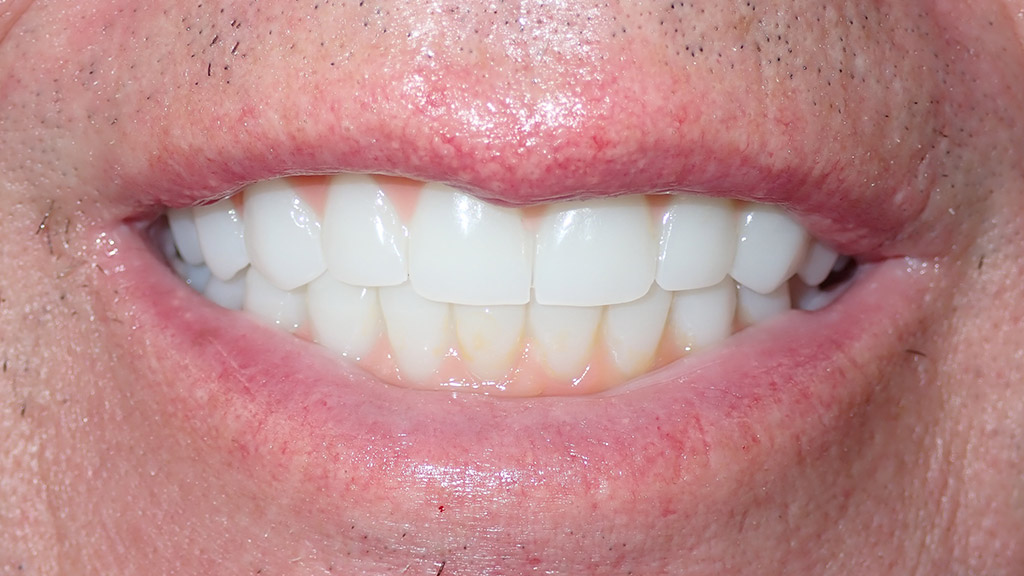 before image