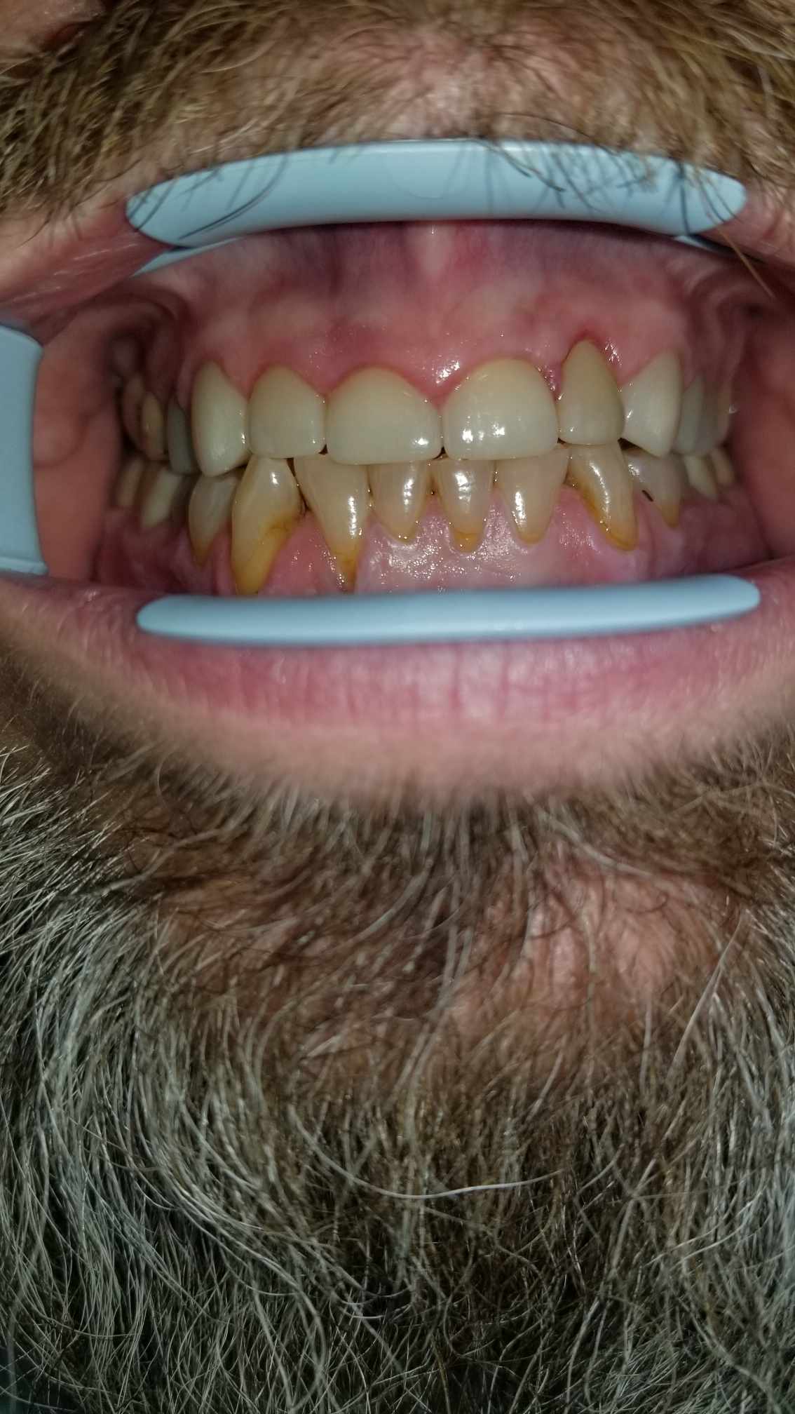 before image